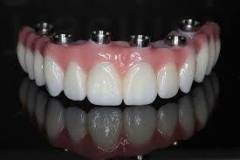 Full mouth Tooth Implant