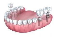 Multiple Tooth Implant