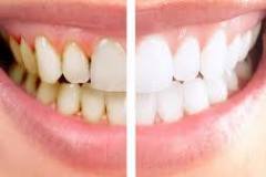 Teeth-Whitening